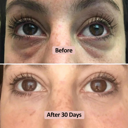 Microneedle Eye Patch